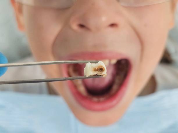 Best Emergency Dentist for Lost Fillings or Crowns in Lynn, MA